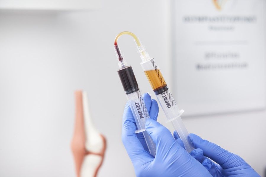 Zwei Spritzen mit aufbereitetem Eigenblut nach der Zentrifugation, daneben ein Kniegelenk-Modell